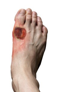 Diabetic Foot and Chronic Wound Care