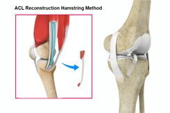 ACL Reconstruction Hamstring Tendon