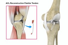 ACL Reconstruction Patellar tendon