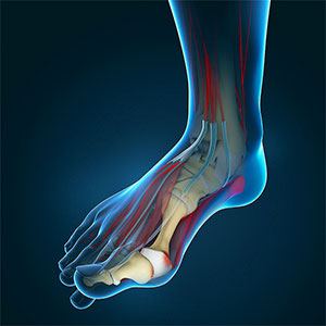 Bunion Surgery