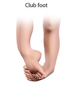 Club foot and Congenital Deformity