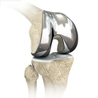 Custom-fitted Total Knee Arthroplasty