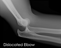 Elbow Dislocation