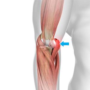 Epicondylitis medial Medial Versus