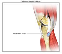 Goosefoot Bursitis of the Knee