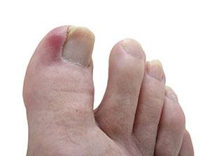 Ingrown toenail