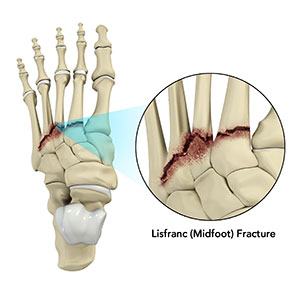 Lisfranc (Midfoot) Fracture