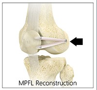 Patellar Tendon Repair