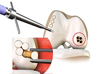 Patellar Tendon Repair