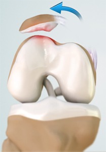 Patellar Dislocation