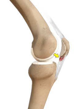 Patellar Tendinitis