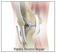 Patellar Tendon Repair