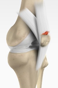 Recurrent Patella Dislocation