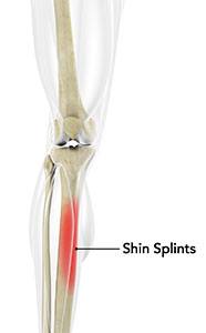 Shin Splints