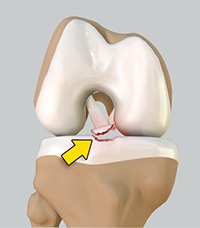 Tibial Eminence Spine Avulsions