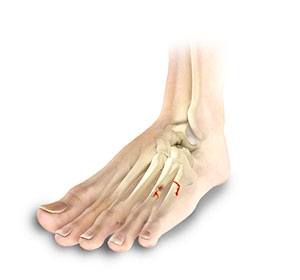 Toe and Forefoot Fractures
