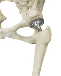 Total Hip Replacement