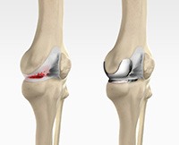 Unicompartmental Knee Replacement 