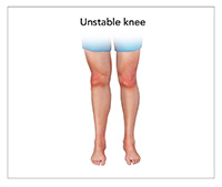 Unstable Knee